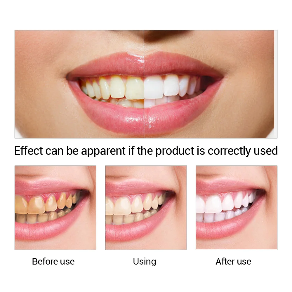 FTEENPLY Zahnaufhellung Essenz – Teeth Whitening Vape Bewertung und Preis