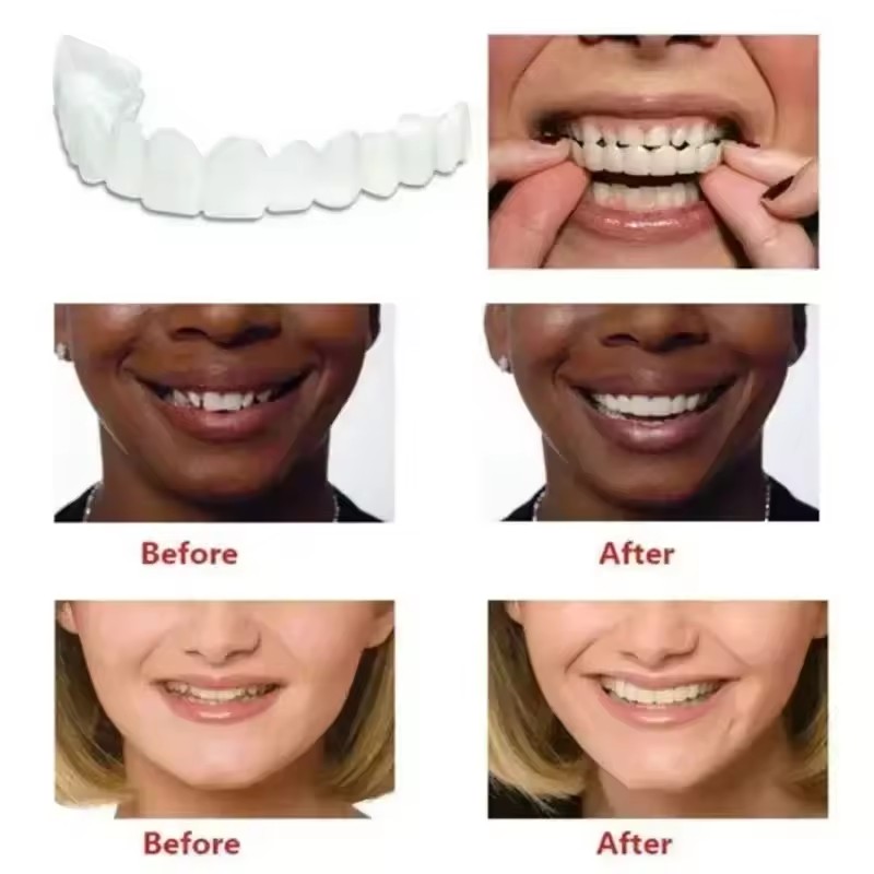 Zahn-Veneers Zahnaufhellung Za – Teeth Whitening Vape Bewertung und Preis