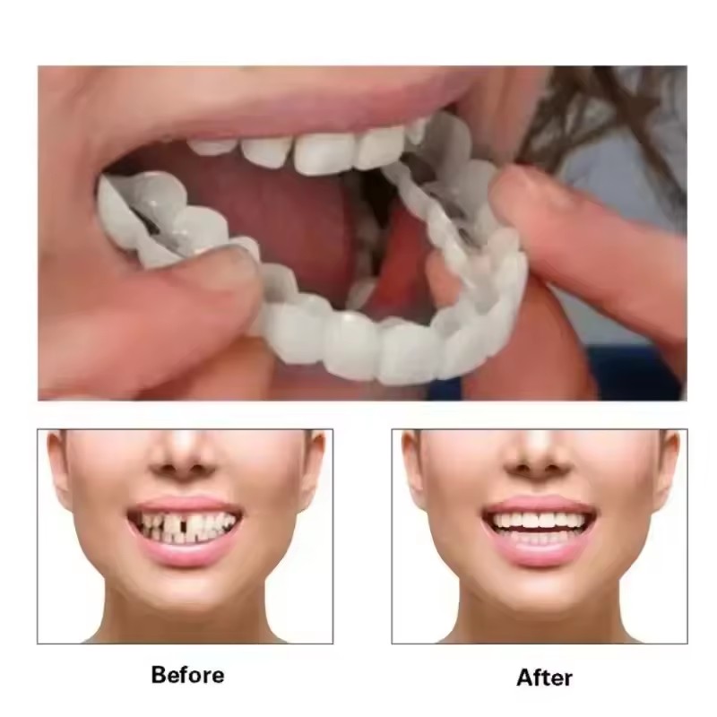 Zahn-Veneers Zahnaufhellung Za – Teeth Whitening Vape Bewertung und Preis