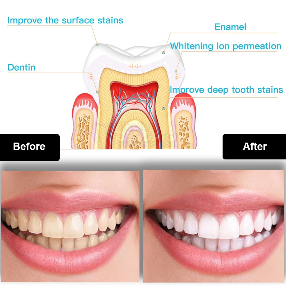 Dental Zahnaufhellung Kit Mini – Teeth Whitening With Trays Bewertung und Preis