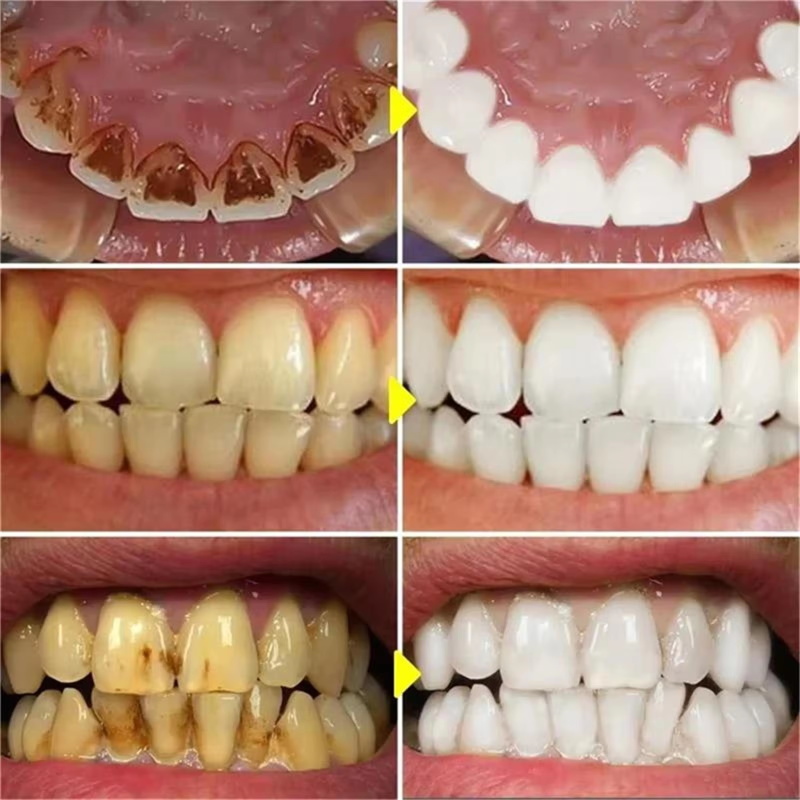 V34 Zahnaufhellungsstift Zahnp – Whitening Pen Bleach Bewertung und Preis