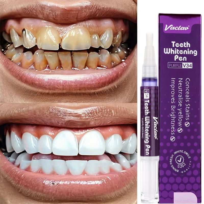V34 Zahnaufhellungsstift Zahnp – Whitening Pen Bleach Bewertung und Preis