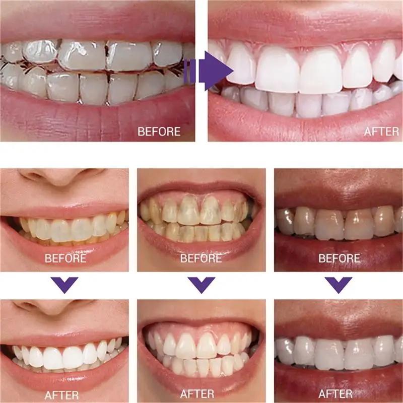 Schnelle Zahnaufhellung Zahnpa – Whitening Pen Bleach Bewertung und Preis